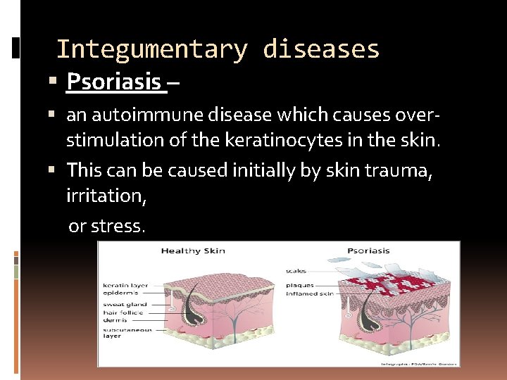 Integumentary diseases Psoriasis – an autoimmune disease which causes overstimulation of the keratinocytes in