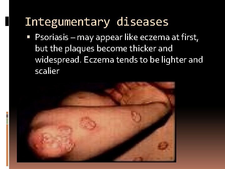Integumentary diseases Psoriasis – may appear like eczema at first, but the plaques become