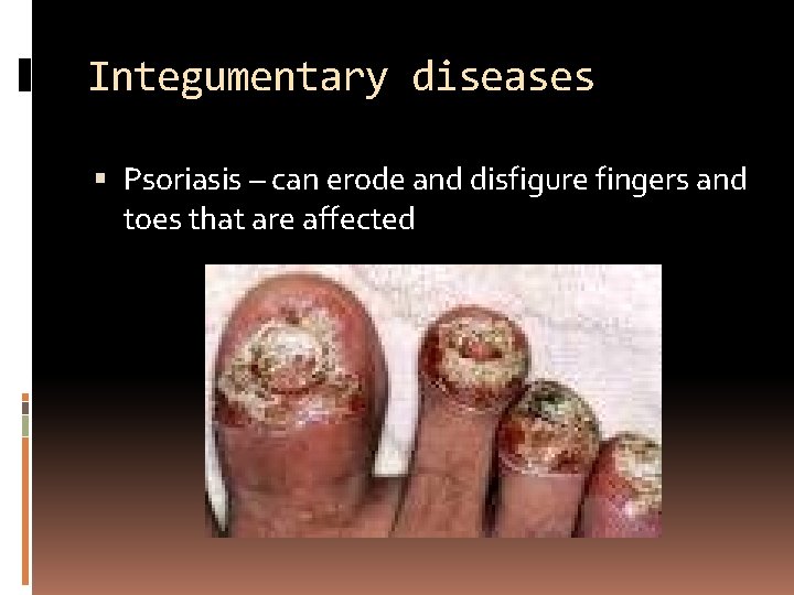 Integumentary diseases Psoriasis – can erode and disfigure fingers and toes that are affected