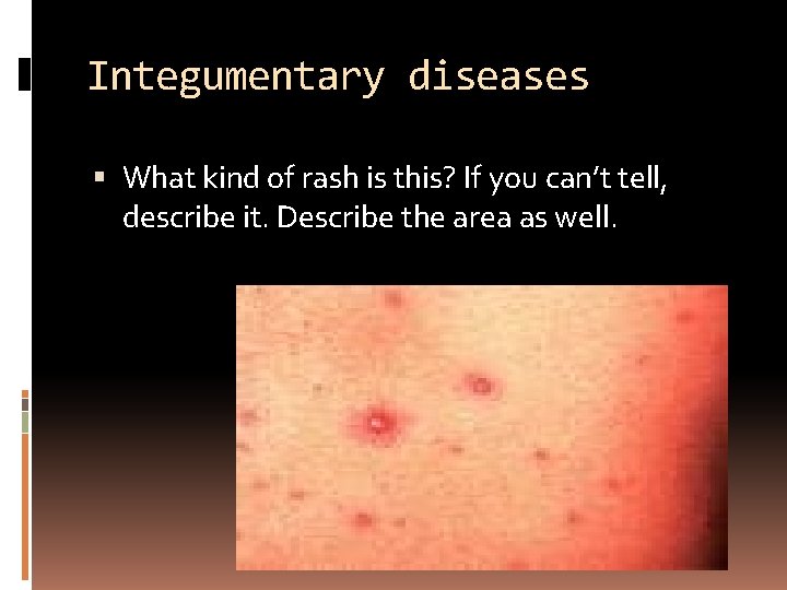 Integumentary diseases What kind of rash is this? If you can’t tell, describe it.