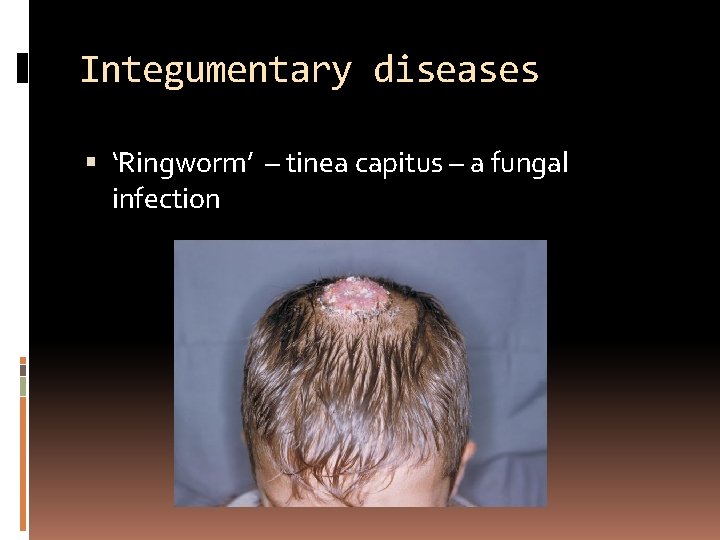 Integumentary diseases ‘Ringworm’ – tinea capitus – a fungal infection 