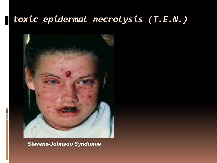 toxic epidermal necrolysis (T. E. N. ) Stevens-Johnson Syndrome 