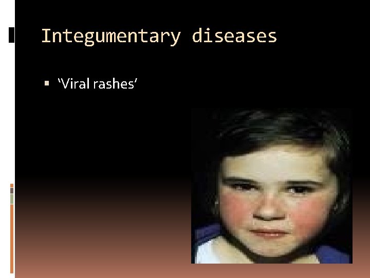 Integumentary diseases ‘Viral rashes’ 