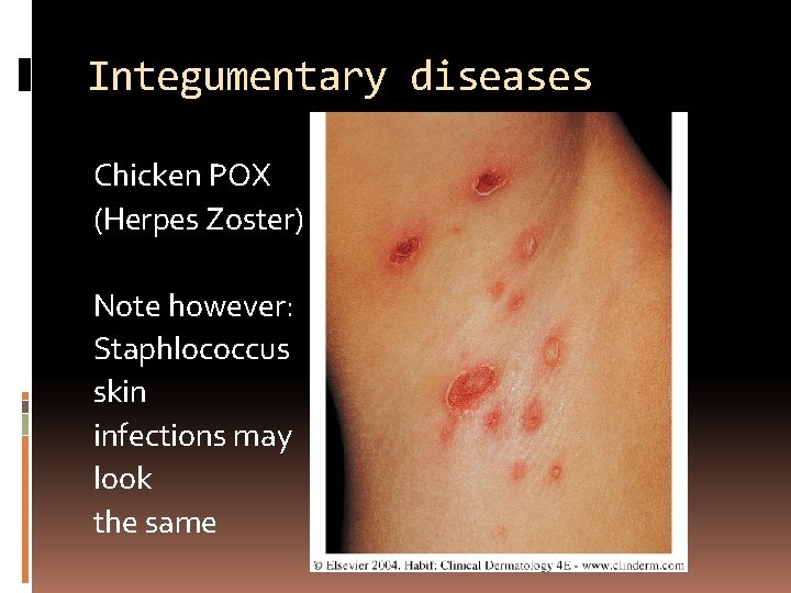 Integumentary diseases Chicken POX (Herpes Zoster) Note however: Staphlococcus skin infections may look the