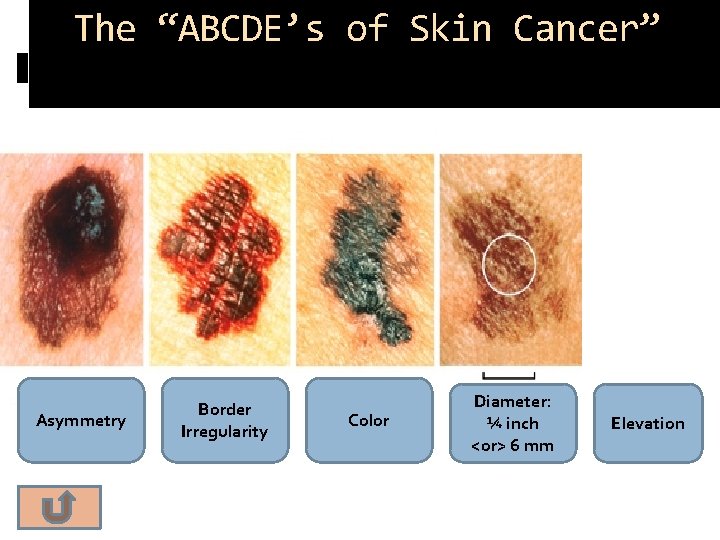 The “ABCDE’s of Skin Cancer” Asymmetry Border Irregularity Color Diameter: ¼ inch <or> 6