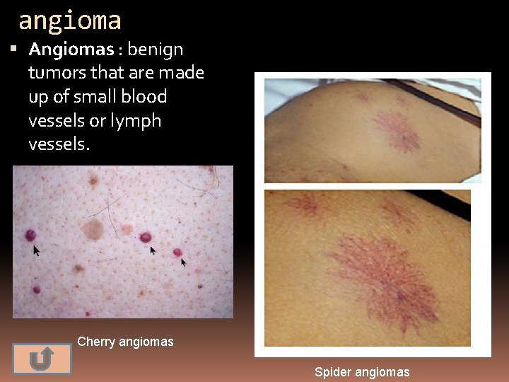 angioma Angiomas : benign tumors that are made up of small blood vessels or