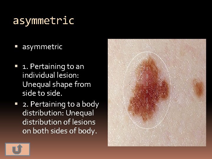asymmetric 1. Pertaining to an individual lesion: Unequal shape from side to side. 2.
