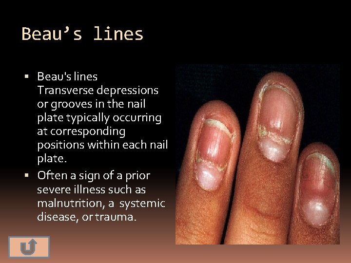 Beau’s lines Beau's lines Transverse depressions or grooves in the nail plate typically occurring
