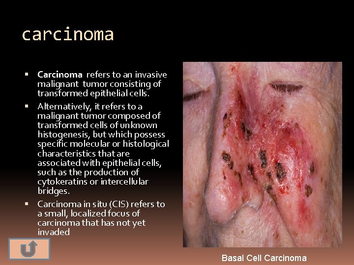 carcinoma Carcinoma refers to an invasive malignant tumor consisting of transformed epithelial cells. Alternatively,