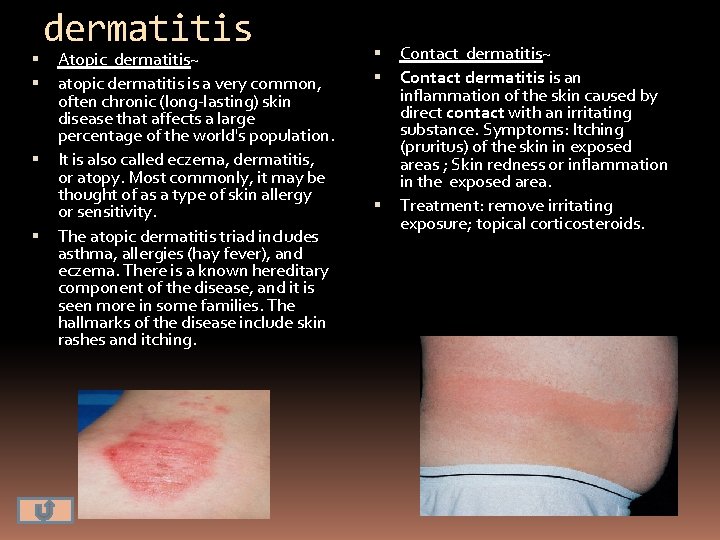  dermatitis Atopic dermatitis~ atopic dermatitis is a very common, often chronic (long-lasting) skin