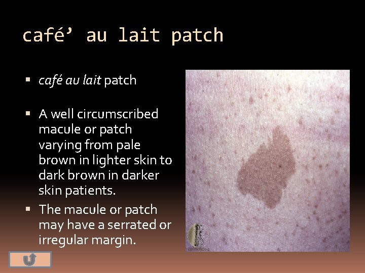café’ au lait patch café au lait patch A well circumscribed macule or patch