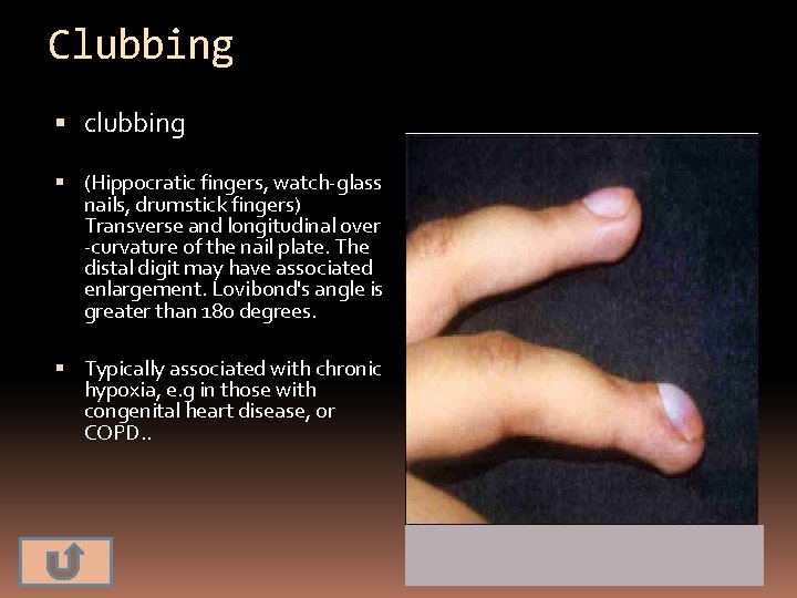 Clubbing clubbing (Hippocratic fingers, watch-glass nails, drumstick fingers) Transverse and longitudinal over -curvature of