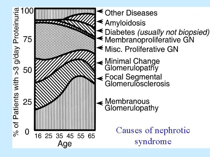 Causes of nephrotic syndrome 