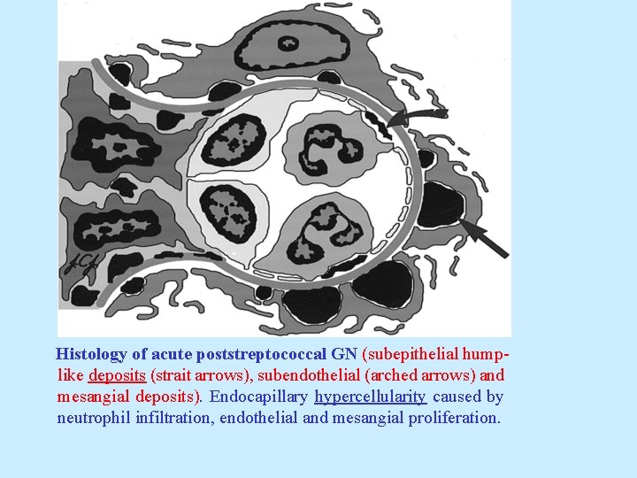 Histology of acute poststreptococcal GN (subepithelial humplike deposits (strait arrows), subendothelial (arched arrows) and