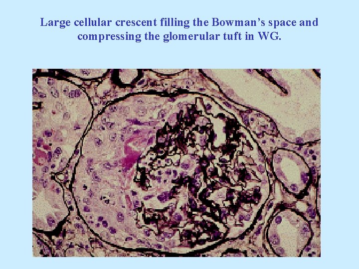 Large cellular crescent filling the Bowman’s space and compressing the glomerular tuft in WG.