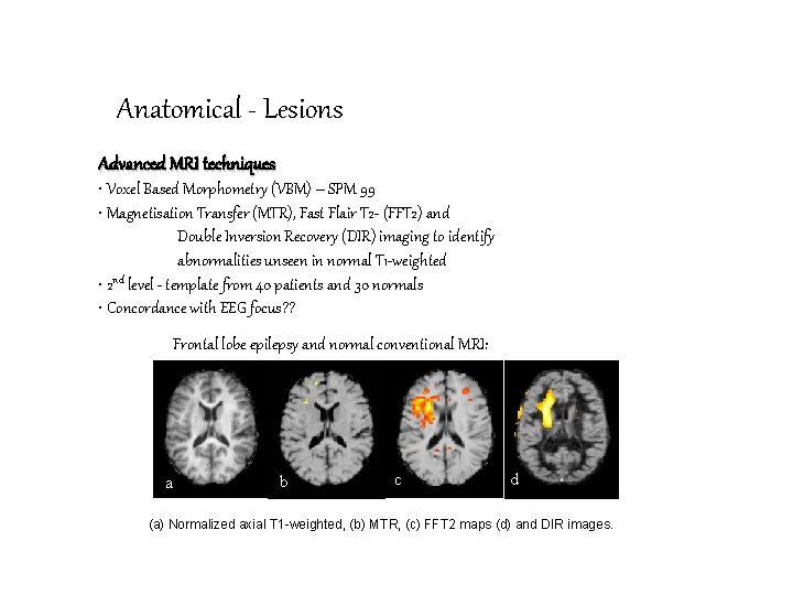 Anatomical - Lesions Advanced MRI techniques • Voxel Based Morphometry (VBM) – SPM 99