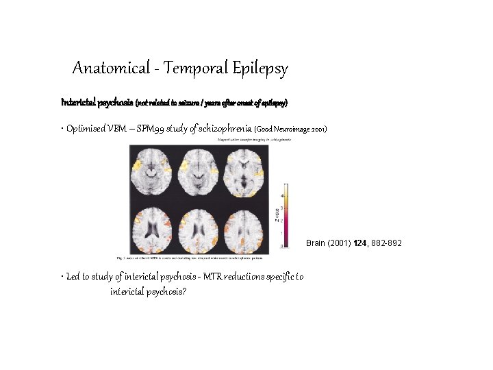 Anatomical - Temporal Epilepsy Interictal psychosis (not related to seizure / years after onset