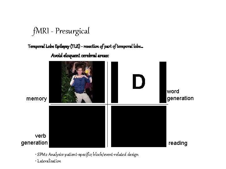 f. MRI - Presurgical Temporal Lobe Epilepsy (TLE) - resection of part of temporal