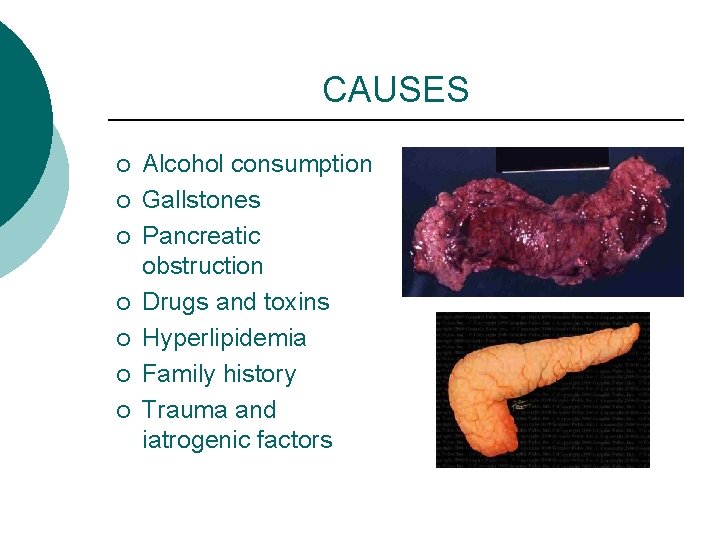 CAUSES ¡ ¡ ¡ ¡ Alcohol consumption Gallstones Pancreatic obstruction Drugs and toxins Hyperlipidemia