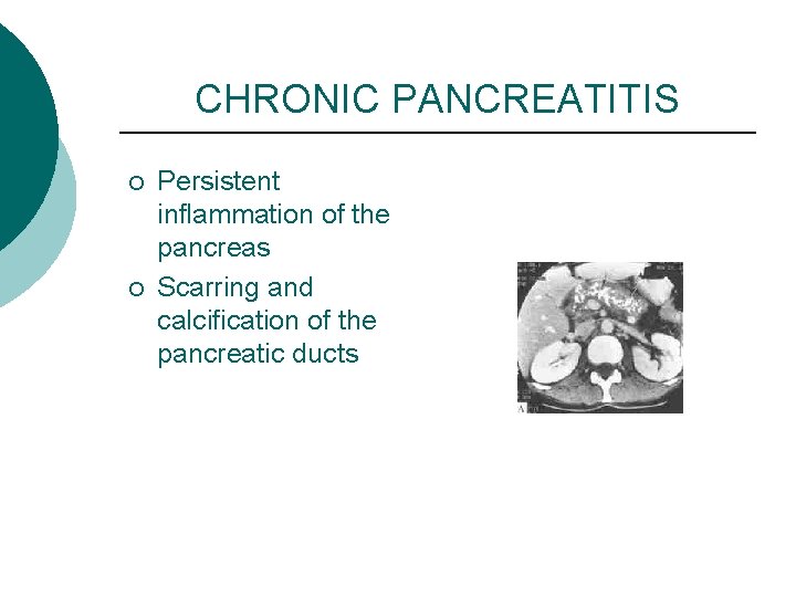 CHRONIC PANCREATITIS ¡ ¡ Persistent inflammation of the pancreas Scarring and calcification of the