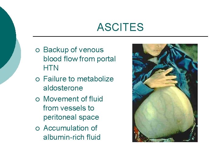 ASCITES ¡ ¡ Backup of venous blood flow from portal HTN Failure to metabolize