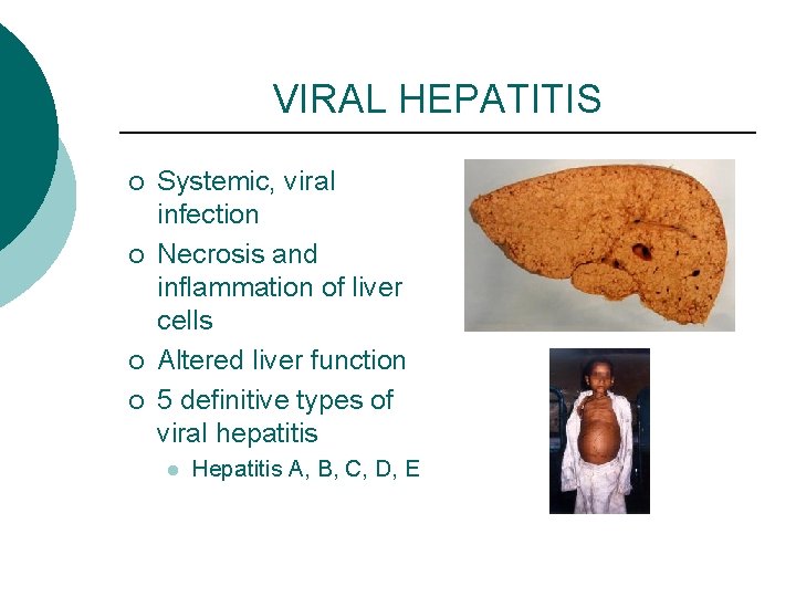 VIRAL HEPATITIS ¡ ¡ Systemic, viral infection Necrosis and inflammation of liver cells Altered