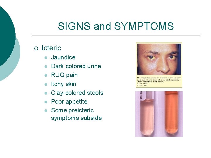 SIGNS and SYMPTOMS ¡ Icteric l l l l Jaundice Dark colored urine RUQ