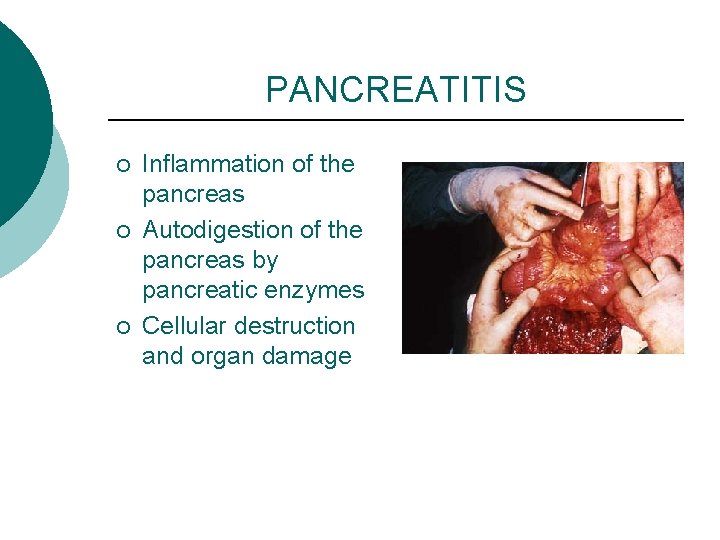 PANCREATITIS ¡ ¡ ¡ Inflammation of the pancreas Autodigestion of the pancreas by pancreatic