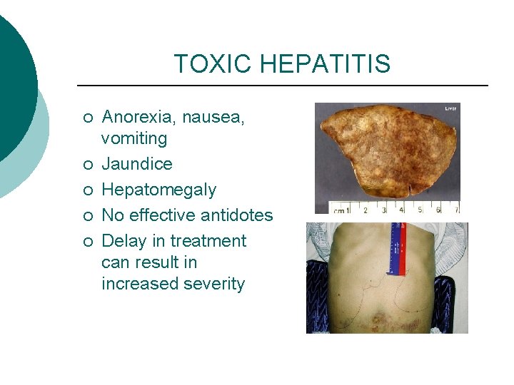 TOXIC HEPATITIS ¡ ¡ ¡ Anorexia, nausea, vomiting Jaundice Hepatomegaly No effective antidotes Delay