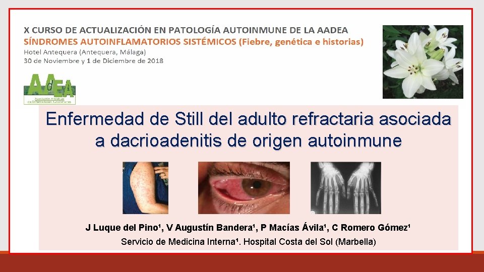 Enfermedad de Still del adulto refractaria asociada a dacrioadenitis de origen autoinmune J Luque