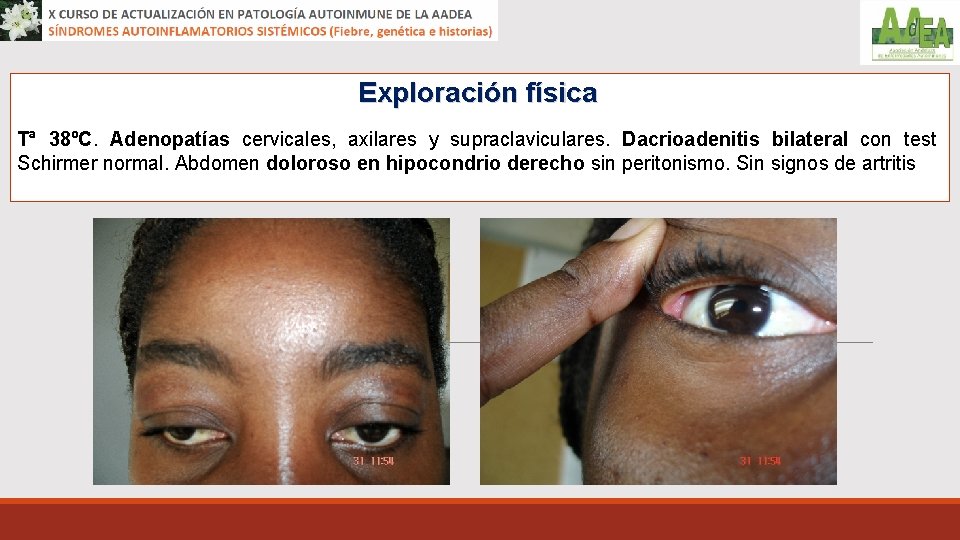 Exploración física Tª 38ºC. Adenopatías cervicales, axilares y supraclaviculares. Dacrioadenitis bilateral con test Schirmer