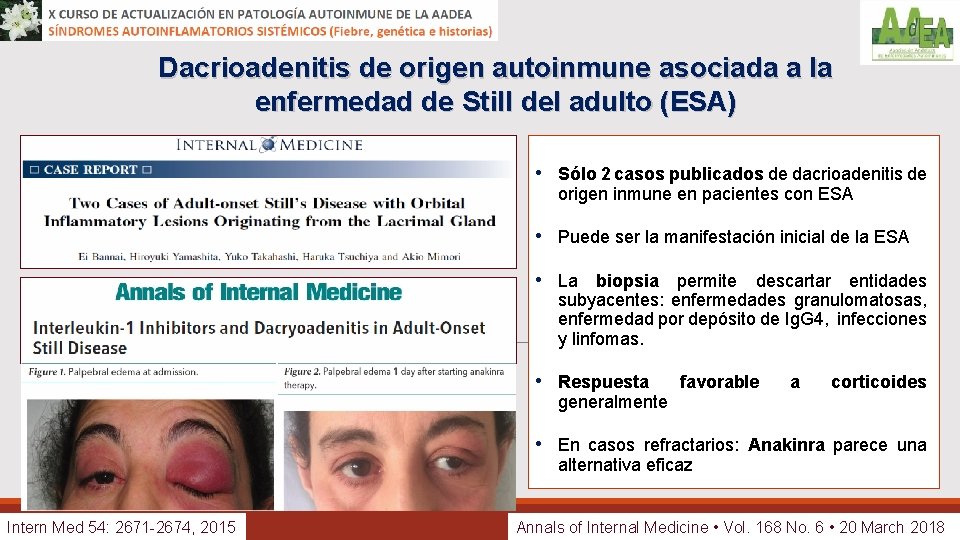 Dacrioadenitis de origen autoinmune asociada a la enfermedad de Still del adulto (ESA) •