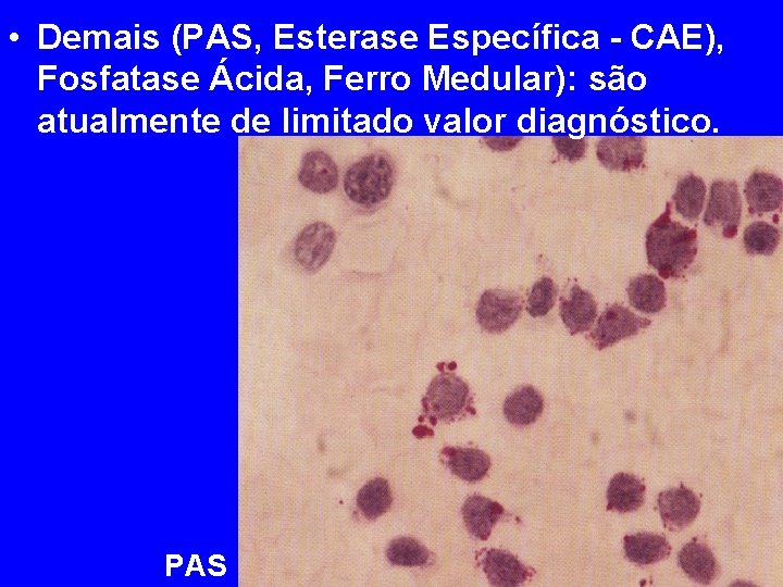 • Demais (PAS, Esterase Específica - CAE), Fosfatase Ácida, Ferro Medular): são atualmente • Demais (PAS, Esterase Específica - CAE), Fosfatase Ácida, Ferro Medular): são atualmente