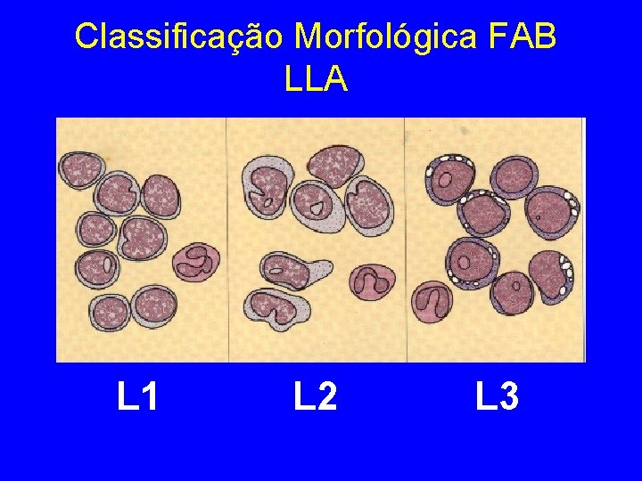 Classificação Morfológica FAB LLA L 1 L 2 L 3 Classificação Morfológica FAB LLA L 1 L 2 L 3