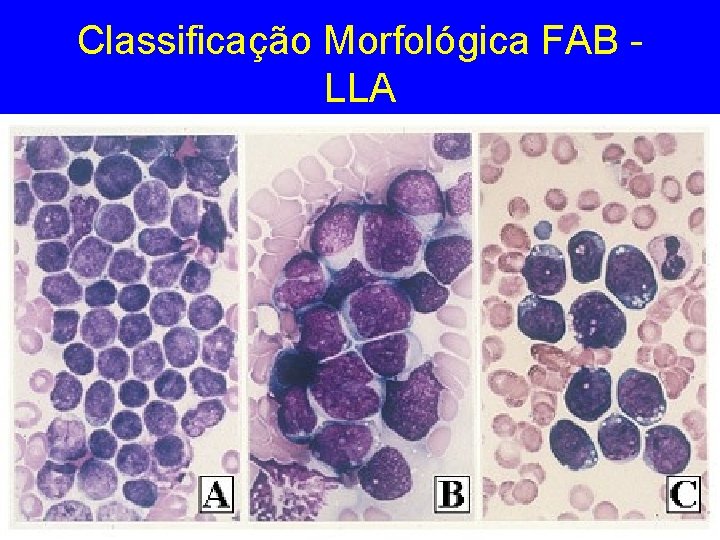 Classificação Morfológica FAB LLA Classificação Morfológica FAB LLA