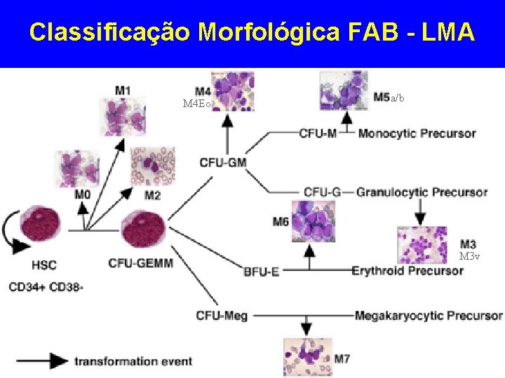 Classificação Morfológica FAB - LMA M 4 Eo a/b M 3 v Classificação Morfológica FAB - LMA M 4 Eo a/b M 3 v