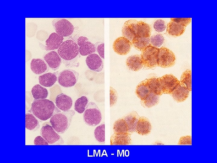LMA - M 0 LMA - M 0