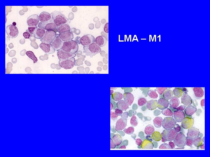 LMA – M 1 LMA – M 1
