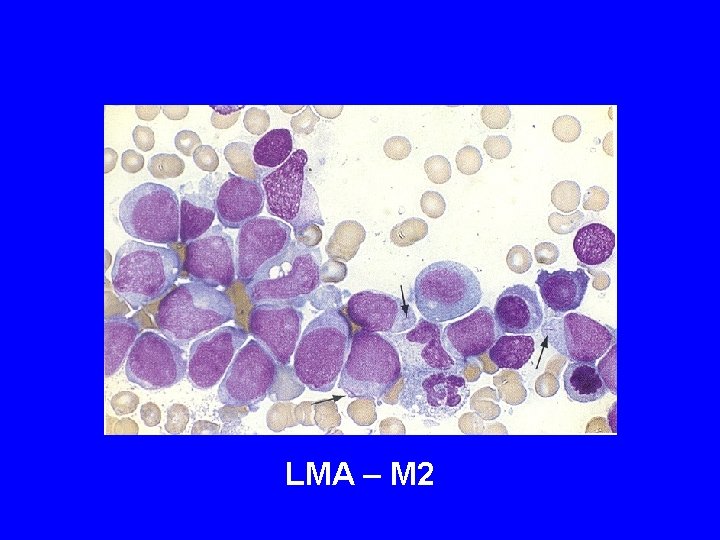 LMA – M 2 LMA – M 2
