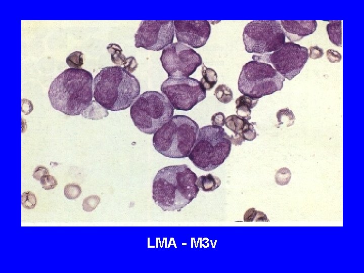 LMA - M 3 v LMA - M 3 v