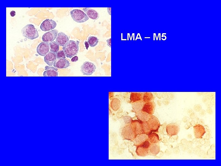 LMA – M 5 LMA – M 5