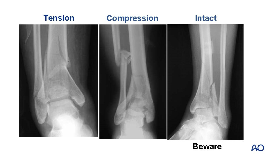 Tension Compression Intact Beware 