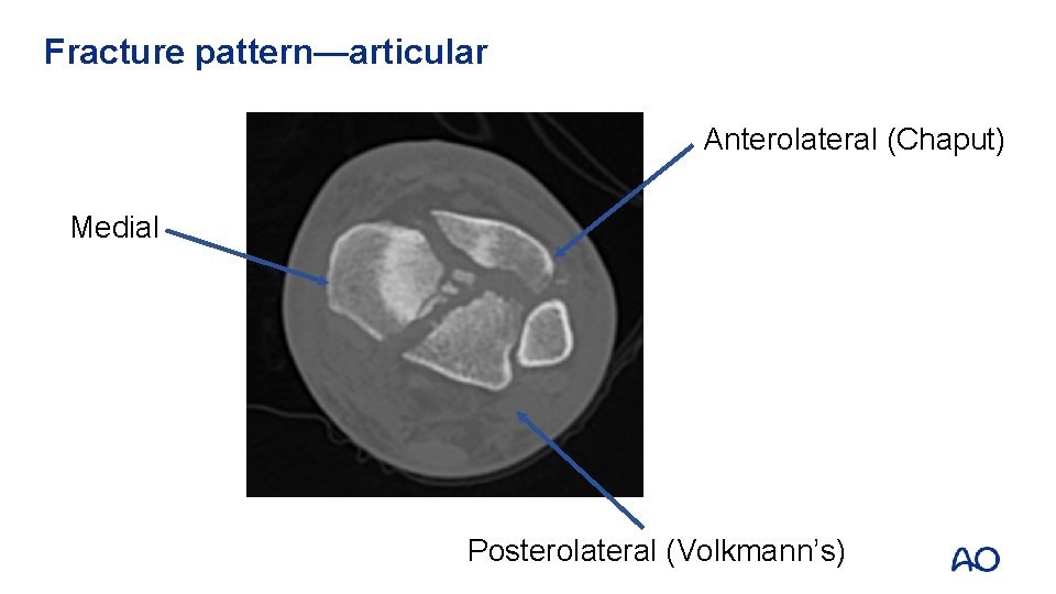 Fracture pattern—articular Anterolateral (Chaput) Medial Posterolateral (Volkmann’s) 