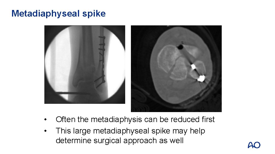 Metadiaphyseal spike • • Often the metadiaphysis can be reduced first This large metadiaphyseal