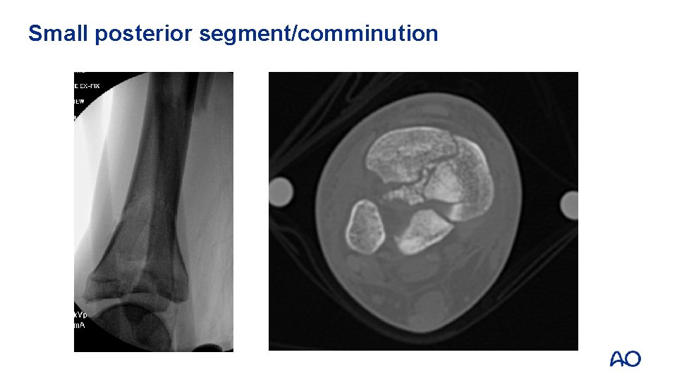 Small posterior segment/comminution 