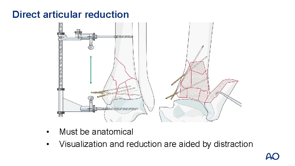 Direct articular reduction • • Must be anatomical Visualization and reduction are aided by