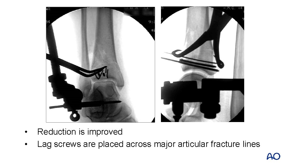 • • Reduction is improved Lag screws are placed across major articular fracture