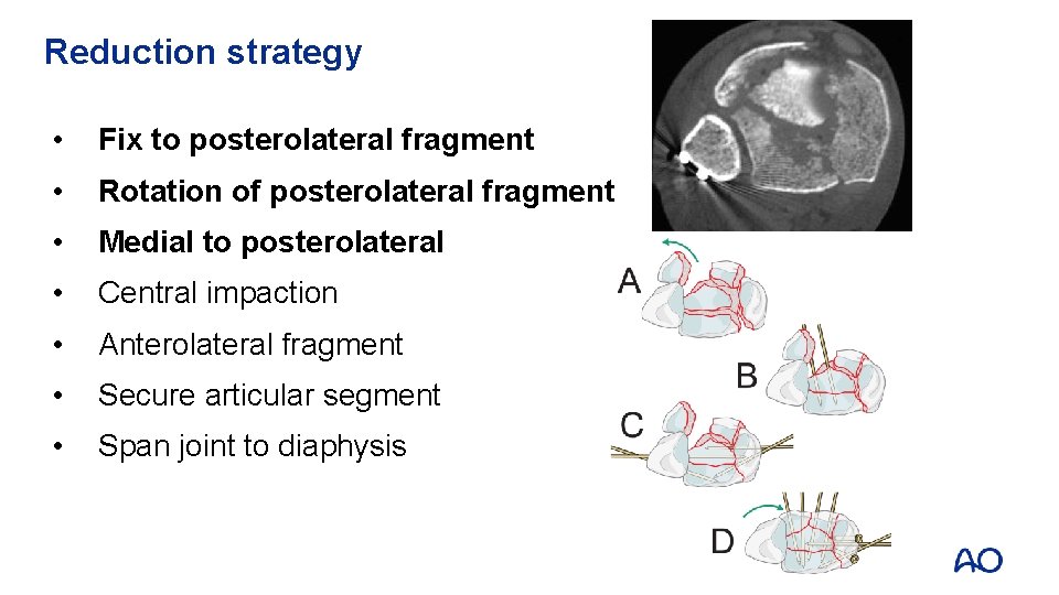 Reduction strategy • Fix to posterolateral fragment • Rotation of posterolateral fragment • Medial