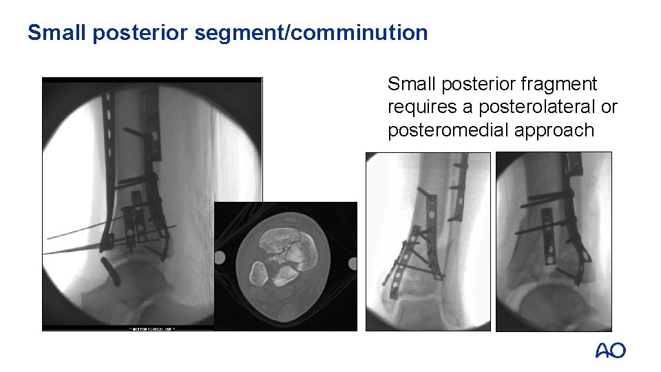 Small posterior segment/comminution Small posterior fragment requires a posterolateral or posteromedial approach 