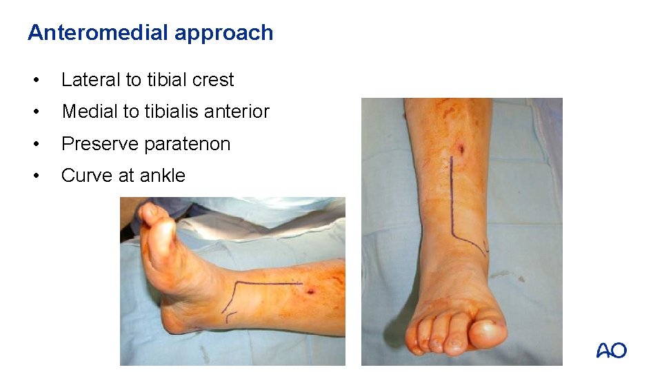 Anteromedial approach • Lateral to tibial crest • Medial to tibialis anterior • Preserve